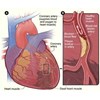 menyembuhkan sakit jantung koroner bergaransi 1 tahun