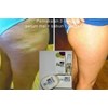 penghilang stretchmark dan selulit aman berbpom dan cepat-2
