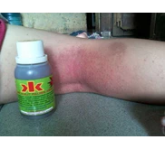 OBAT KULIT PALING AMPUH NO1