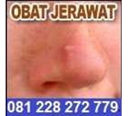 Obat Jerawat dan Darah Kotor 081 228 272 779