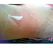 Paket Kojic Kelupas