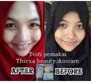 Penghilang Jerawat Dan Lubang Bekas Jerawat Aman Tanpa Efek Samping