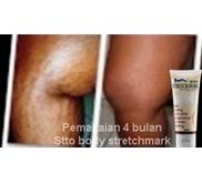 Satto Body Stretchmark ( Cara menghilangkan Stretchmark )