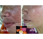 Pemutih kulit dan Penghilang Bopeng Bekas Jerawat
