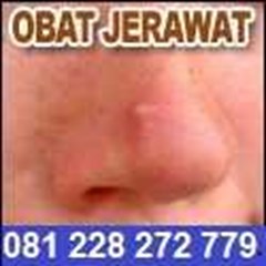 obat jerawat dan darah kotor 081 228 272 779