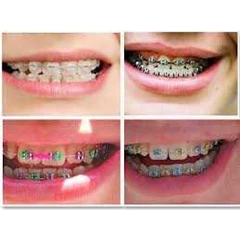 kawat gigi ( bracket/ behel )