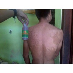 obat panu paling bagus
