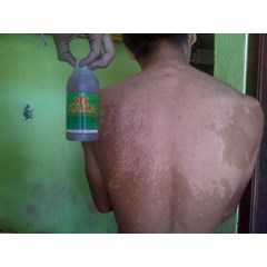 obat panu paling bagus