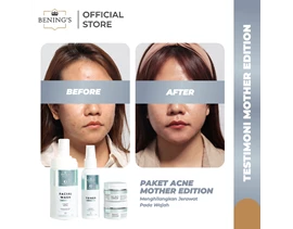 Paket Acne Mother Edition