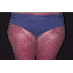 drug for treatment of diseases psoriasis