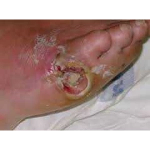 perawatan luka pada luka kaki diabetes militus dengan pureganta oil-2