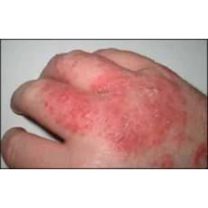 obat ampuh penyakit kulit exim - pakai pureganta oil-1