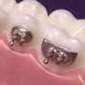 bracket americanortho-3