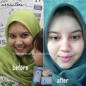 penghilang jerawat dan lubang bekas jerawat aman tanpa efek samping-3