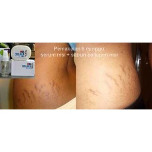penghilang stretchmark dan selulit aman berbpom dan cepat-6