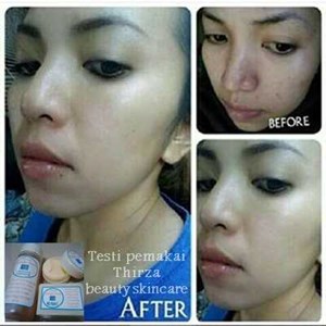 penghilang jerawat dan lubang bekas jerawat aman tanpa efek samping-5