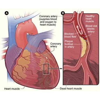 Menyembuhkan sakit jantung koroner bergaransi 1 tahun