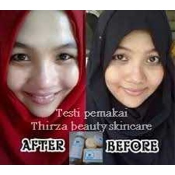 Penghilang Jerawat Dan Lubang Bekas Jerawat Aman Tanpa Efek Samping