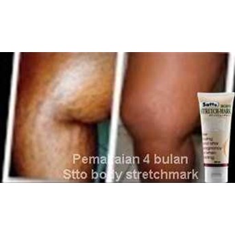 Satto Body Stretchmark ( Cara menghilangkan Stretchmark )