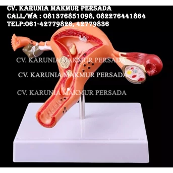 Alat Peraga Model Anatomi Uterus And Ovaries Normal and Pathological