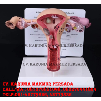 Manekin Alat Peraga Model Anatomi Human Female Uterus Ovary Disease